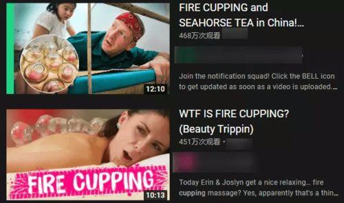 外国人拔火罐视频